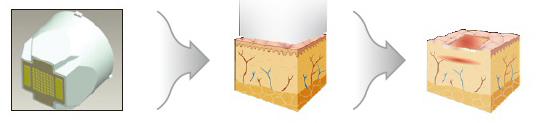 Korea Scarlet Microneedle Fractional RF Machine , Big Touch Screen