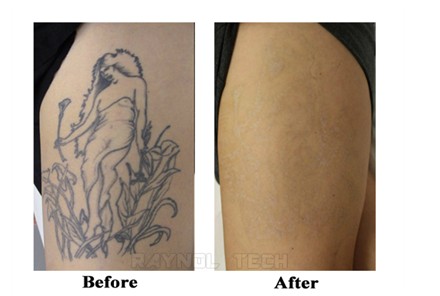 1 10hz active q switched nd yag laser beauty equipment for 1 10hz active q switched nd yag laser beauty equipment for