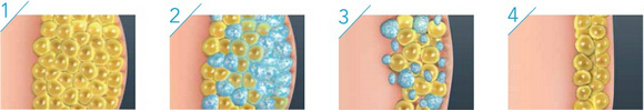 Multifunction Cryolipolysis Slimming Machine with RF and Cavitation