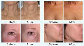 Korea Microneedle Fractional RF Machine for Pore Refining , Acne Scar Removal