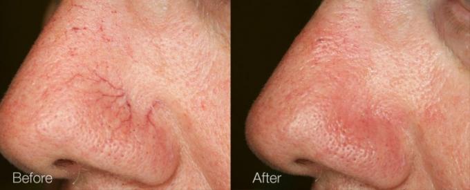 15w Medical Beauty Equipment Laser Spider Vein Removal Touch Screen