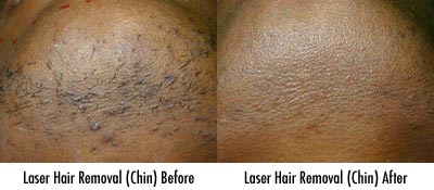 yag laser hair removal