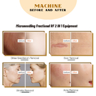 RF Microneedling Laser Machine Face Lift Acne Scar Treatment Machine