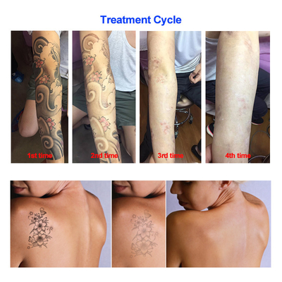 Tattoo Pigment Removal Black Doll Laser Treatment Machine Perfectlaser Picosecond
