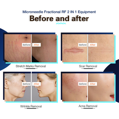 Anti Aging Fractional RF Microneedling Machine Radio Frequency 2 In 1 MRF SRF